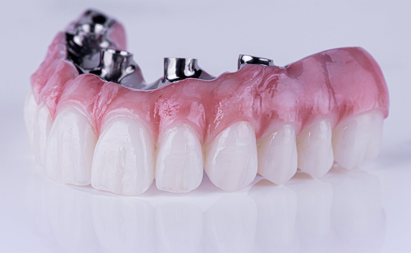 ads signature art upper arch restoration